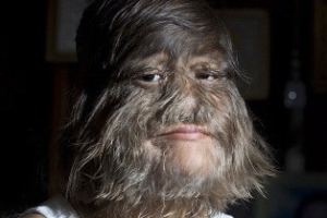 Video Gadis Serigala dari Thailand : Benarkah kelainan hypertrichosis?