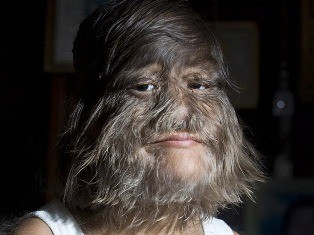 Video Gadis Serigala dari Thailand : Benarkah kelainan hypertrichosis? 1