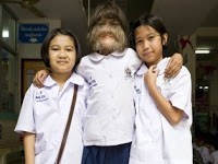 Video Gadis Serigala dari Thailand : Benarkah kelainan hypertrichosis? 2