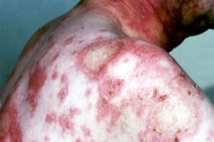 Lupus : Penyakit dengan seribu wajah