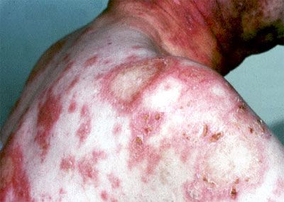 Lupus : Penyakit dengan seribu wajah 2