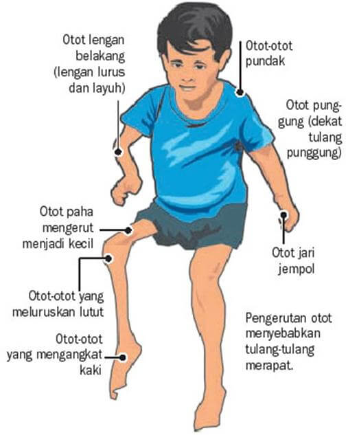 penderita polio