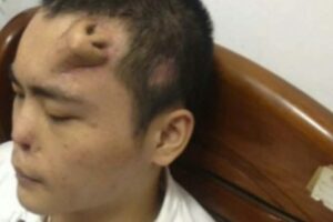 Pria ini tumbuh hidung di dahinya